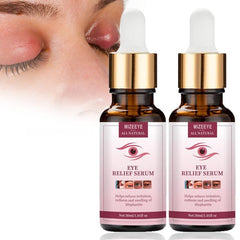 Chalazion Eye Treatment For Blepharitis, 30ml Moisturize Eyelids Serum and Chalazion Remover, Gentle Under Eye Relief Serum For Dark Circles, Eye Bags, Puffiness.